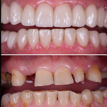 Denture Result 3