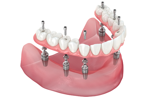 Full-Arch Conversions
